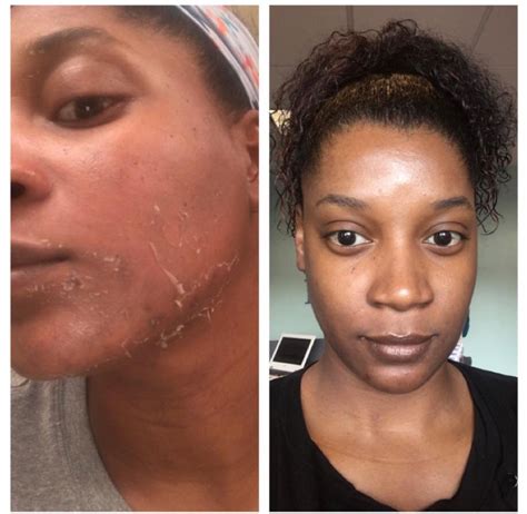 Best Chemical Peels Near Me in Zimbali Estate, Ballito .